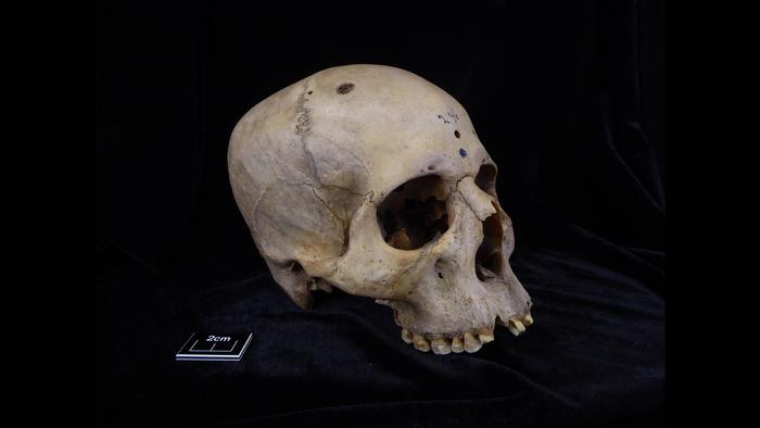 Ricerca, su cranio egiziano di 4mila anni i segni della prima chirurgia anticancro